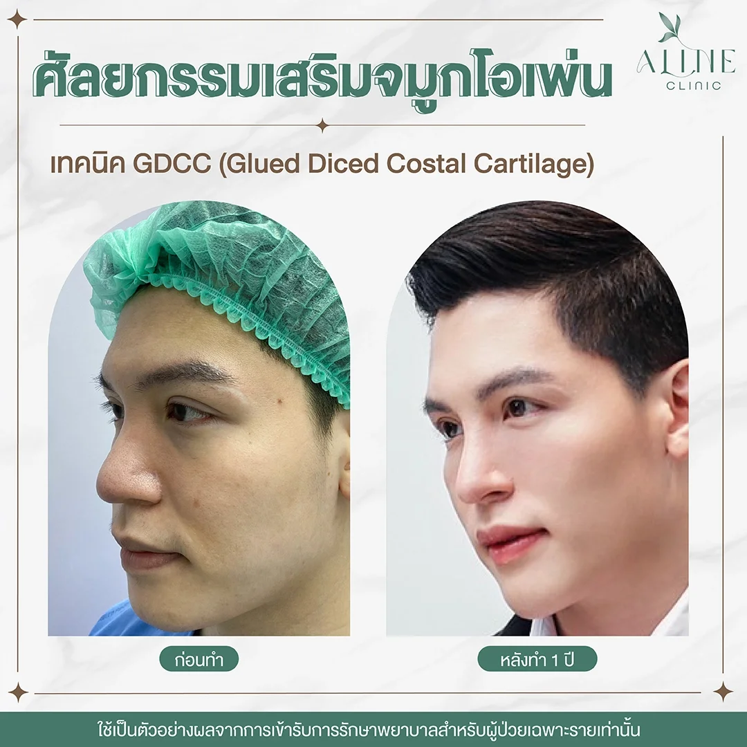 รีวิวเสริมจมูกเทคนิค